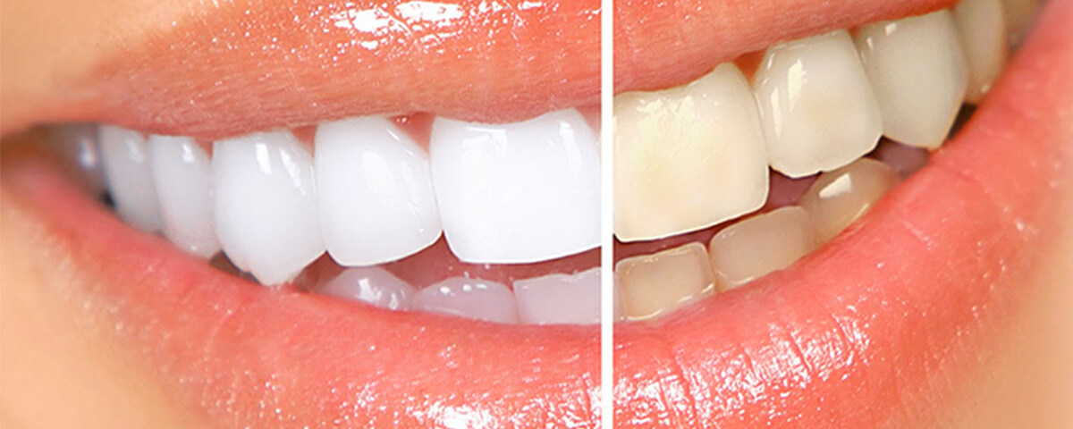 blanqueamento-dental-banner