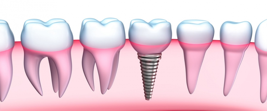 implantes2